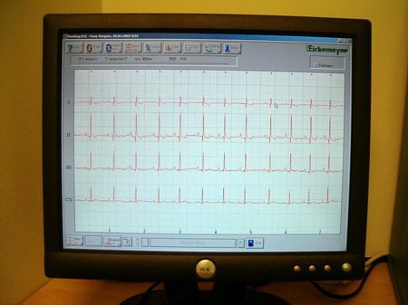 ECG-hartfilmpje